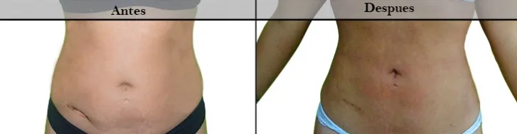 Lipólisis11