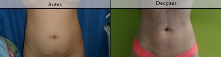 Lipólisis12