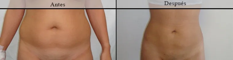 Lipólisis6