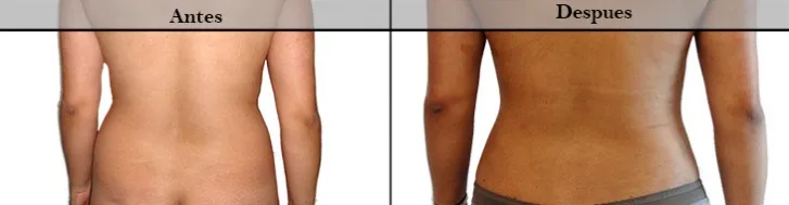 Lipólisis9